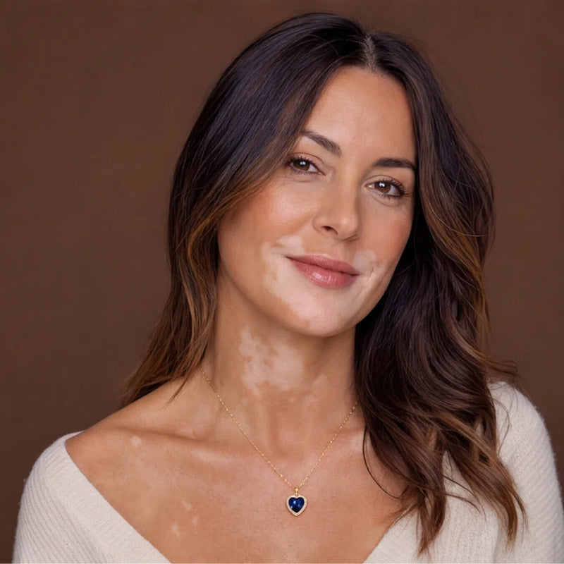 Né du vitiligo.